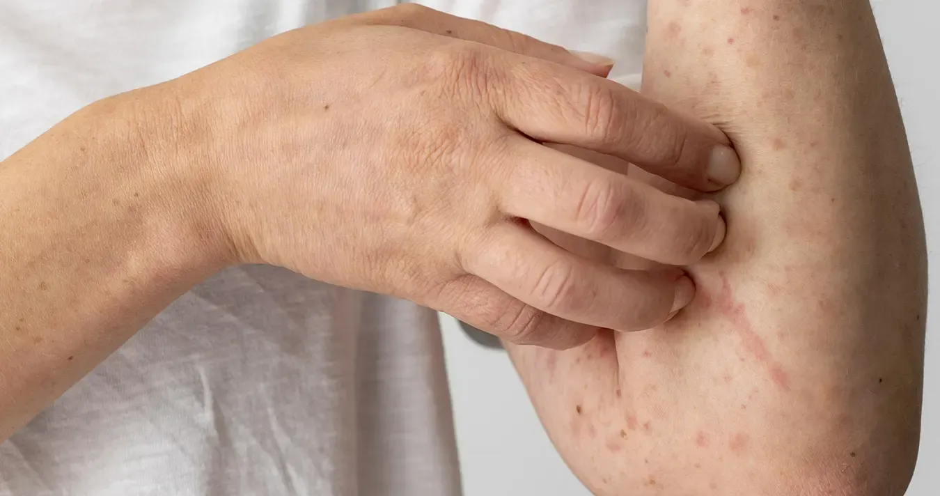 Image of monkeypox on skin